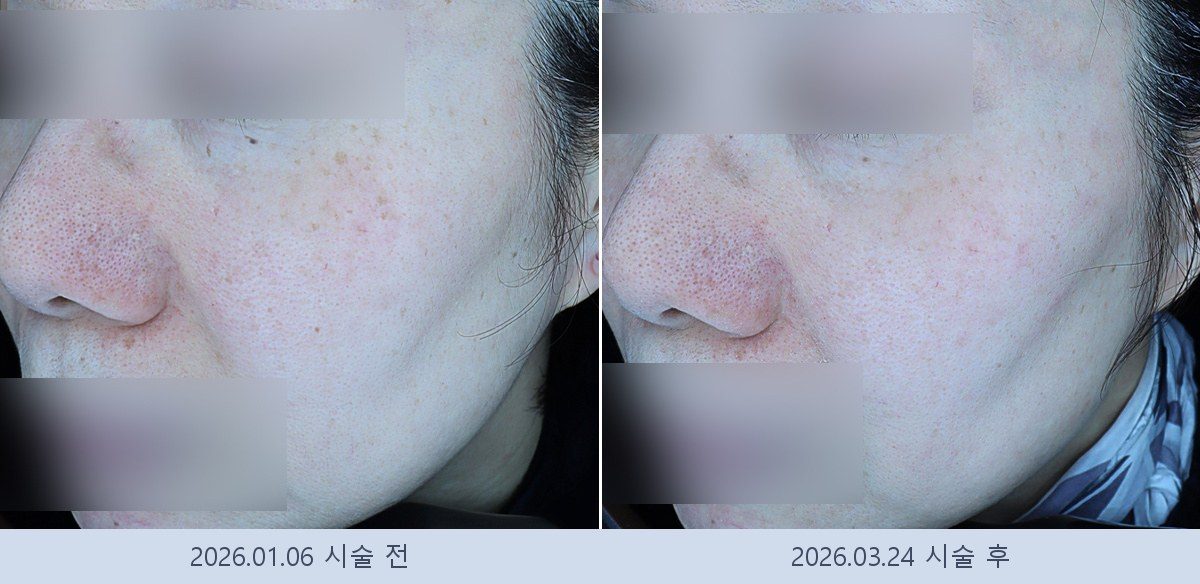 흑자 검버섯